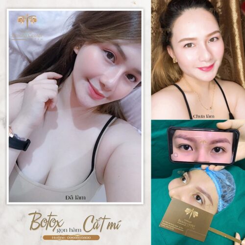 Cắt mí là gì khi nào cần phẫu thuật cắt mí