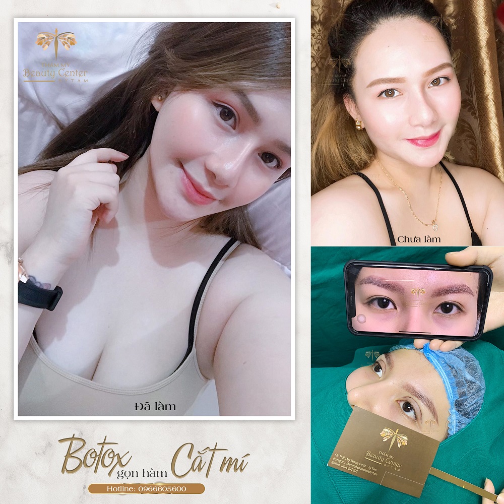 Cắt mí là gì khi nào cần phẫu thuật cắt mí